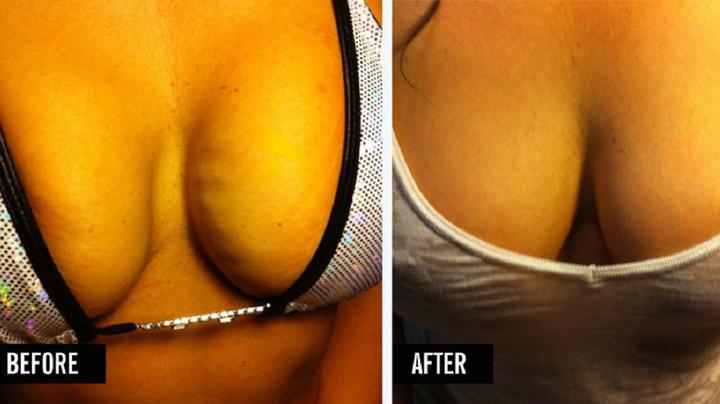 Vampire Breast Lift Before And After