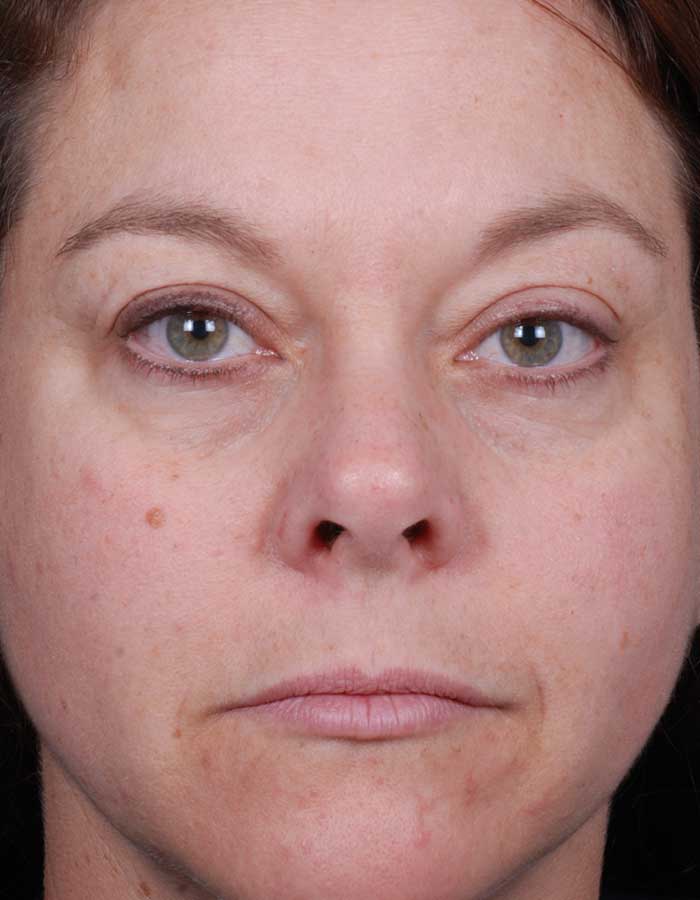 Blue Peels Treatment After