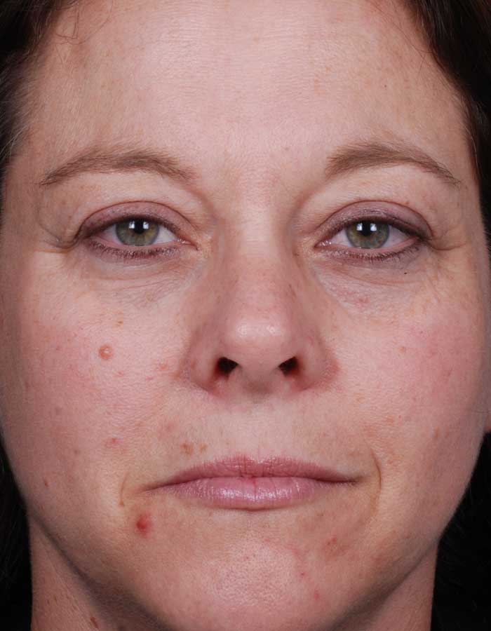 Blue Peels Treatment Before