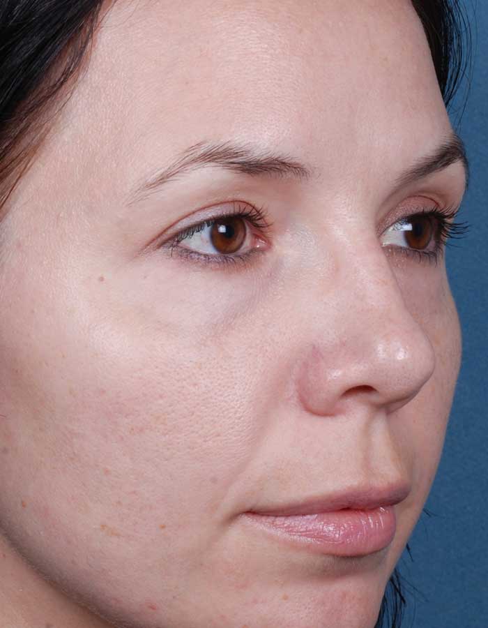 Blue Peels Treatment After