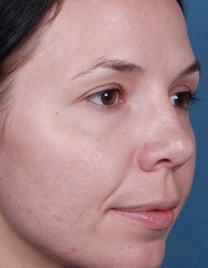 Blue Peels Treatment Before