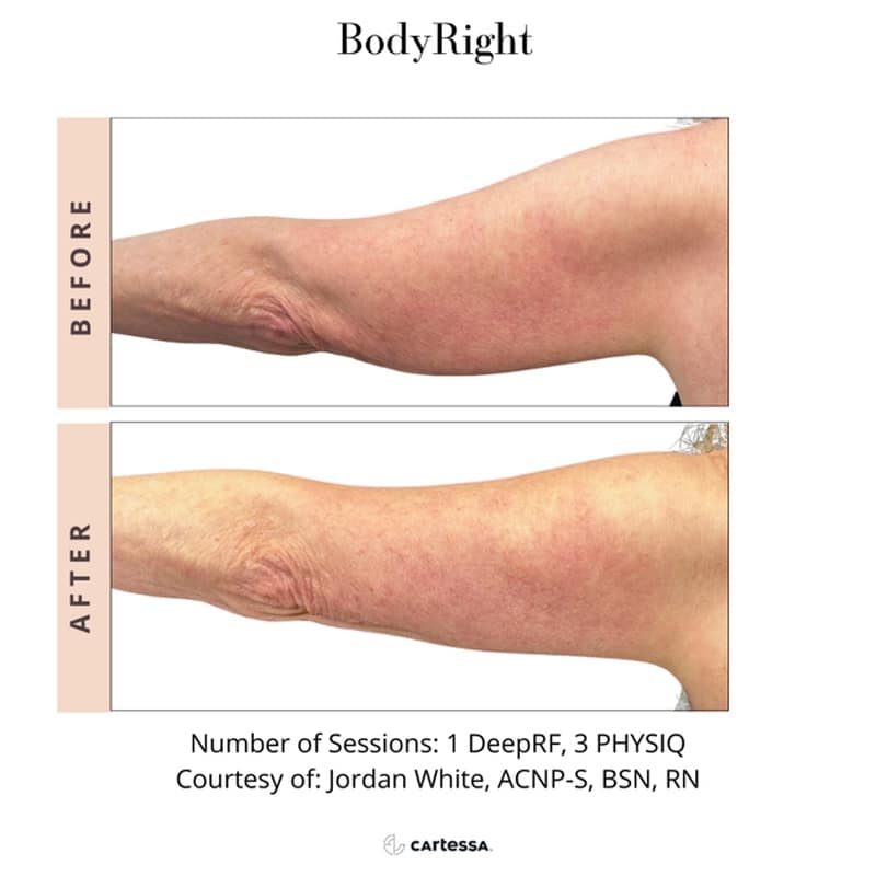 Bodyright Procedure Before After Bodyright Procedure Before After