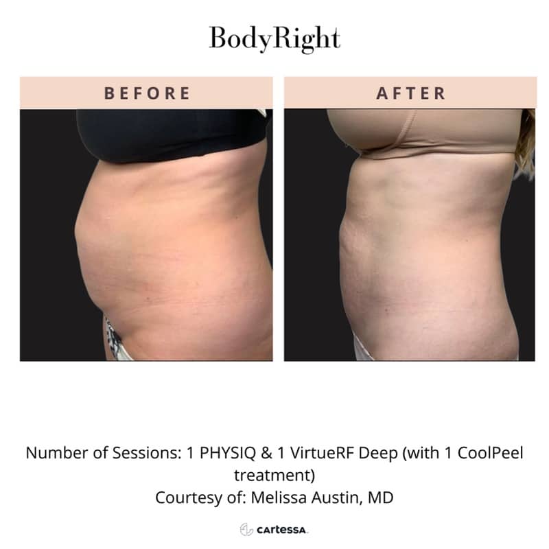 Bodyright Procedure Before After Bodyright Procedure Before After