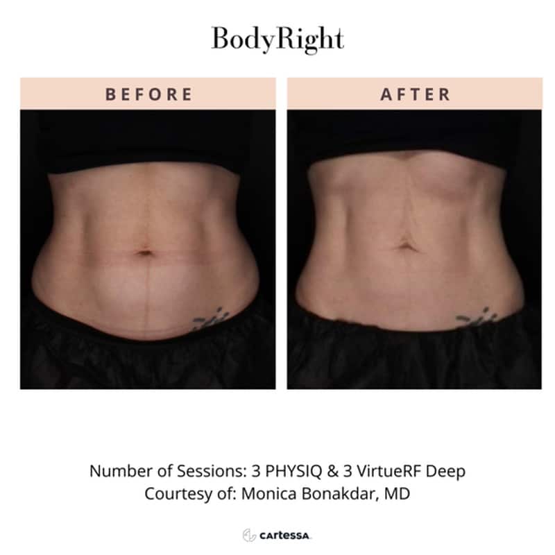 Bodyright Procedure Before After Bodyright Procedure Before After