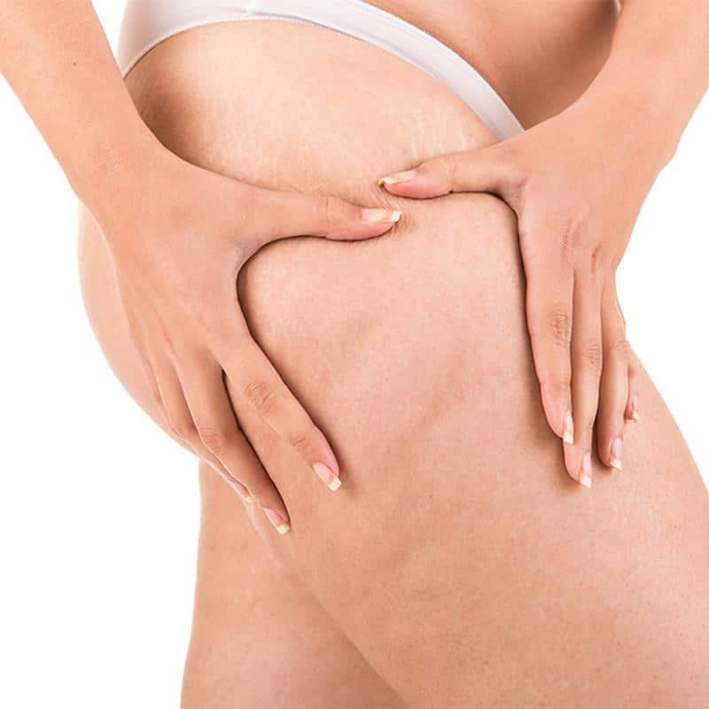 Cellulite Reduction at Contemporary Health Center Cellulite Reduction at Contemporary Health Center