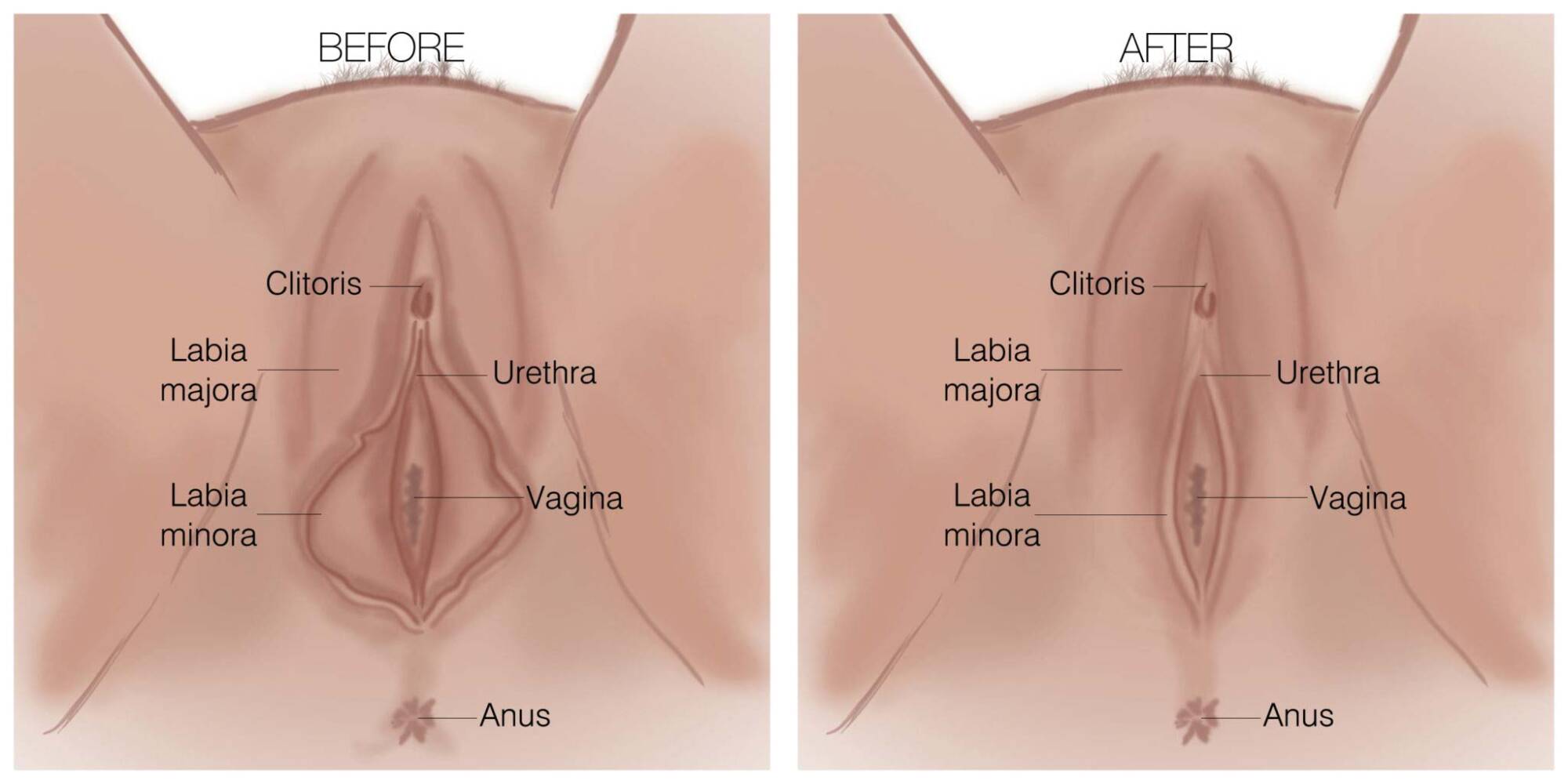Labiaplasty for women in Naples Labiaplasty Before and After Diagram