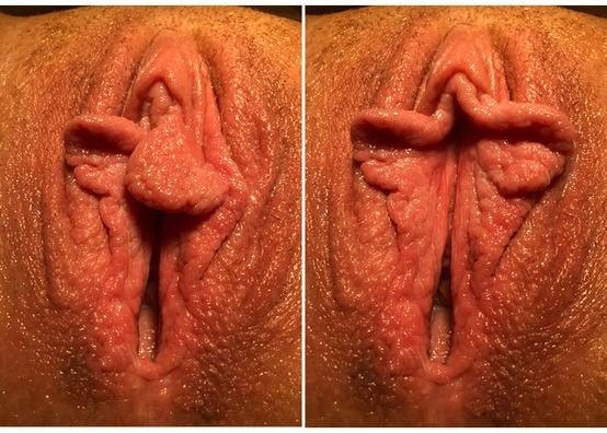 Naples Labiaplasty Labiaplasty for women in Naples