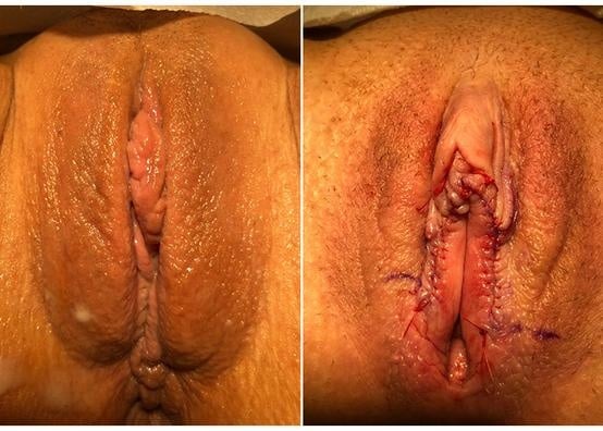 Naples Labiaplasty Labiaplasty for women in Naples