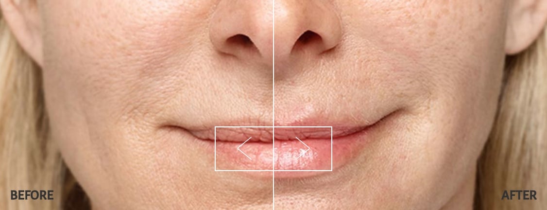 Restylane Silk Lip Filler Before and After Restylane Silk Lip Filler Before and After