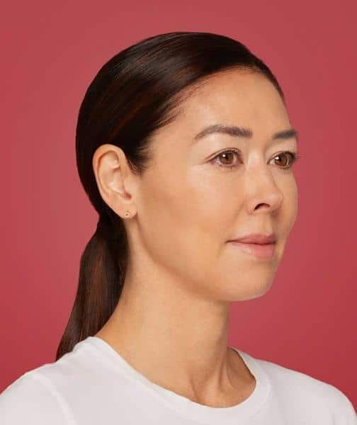 Restylane Cheek Filler After