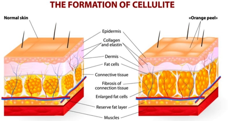 Learn more about cellulite Learn more about cellulite