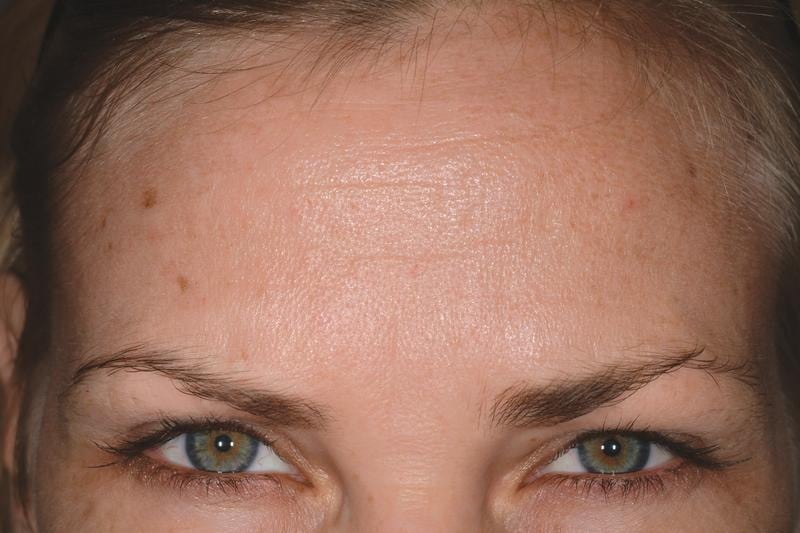 Dysport Ani Frown Line Treatment After