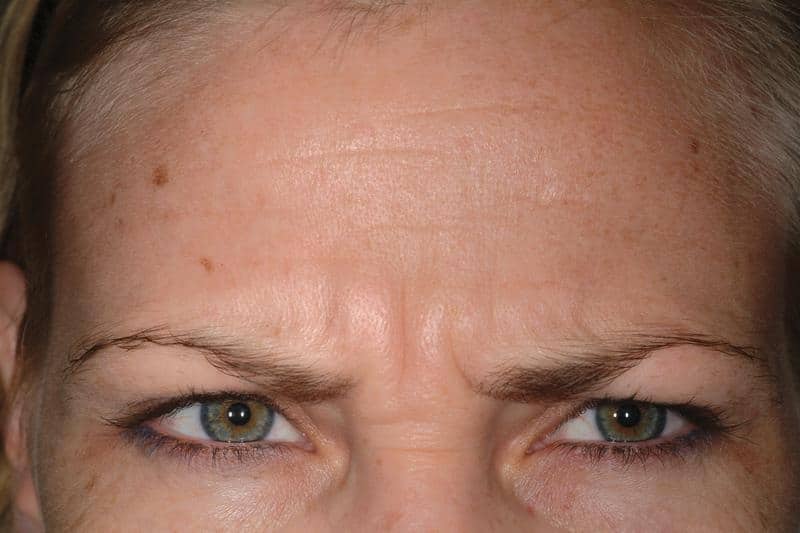 Dysport Ani Frown Line Treatment Before