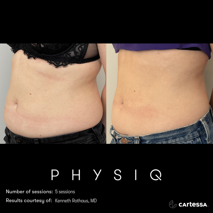 physiq 360 body contouring results before and after