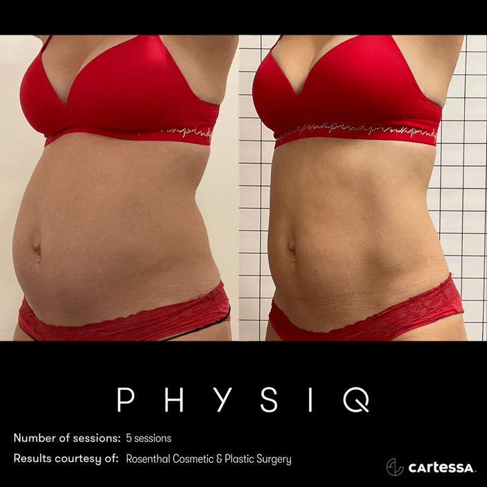 physiq 360 body contouring results before and after