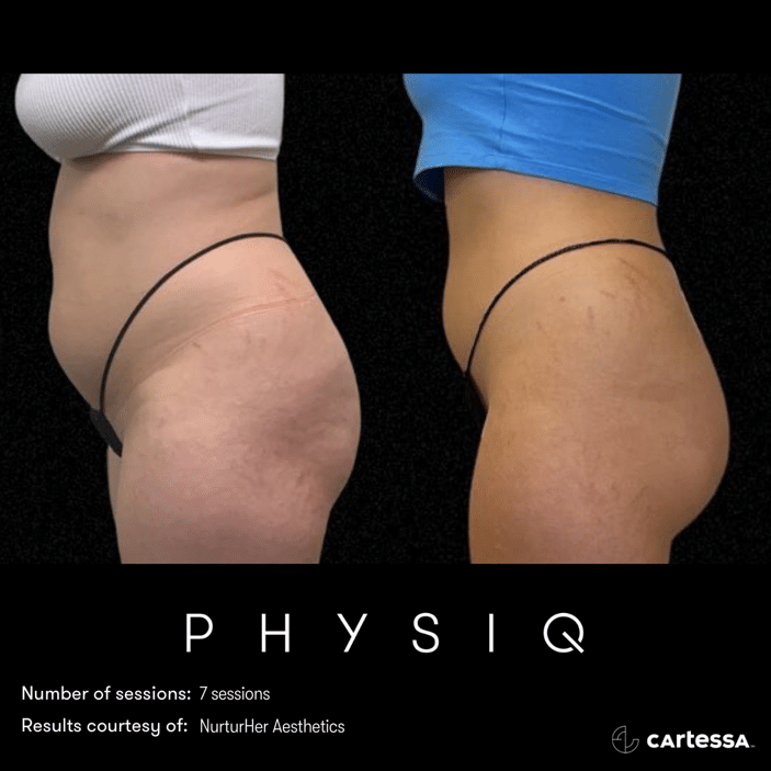 physiq 360 body contouring results before and after