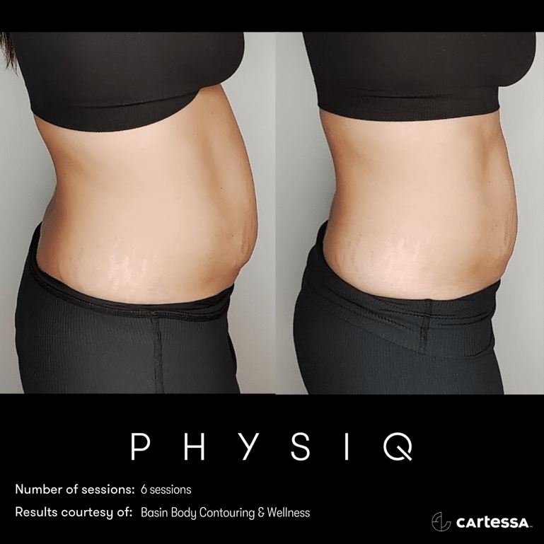 physiq 360 body contouring results before and after