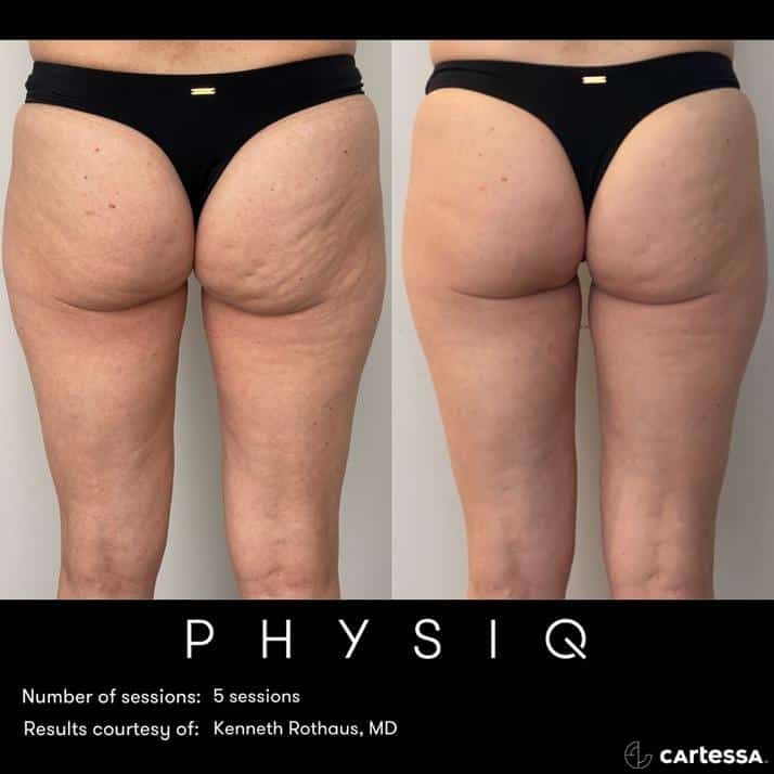 physiq 360 body contouring results before and after