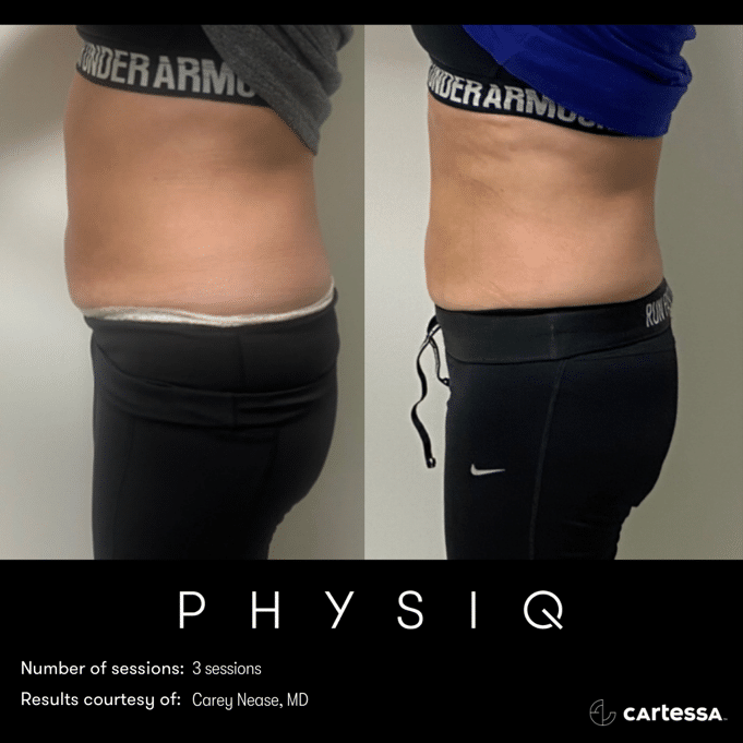 physiq 360 body contouring results before and after