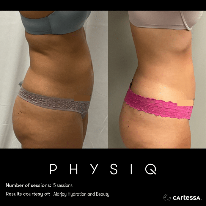 physiq 360 body contouring results before and after