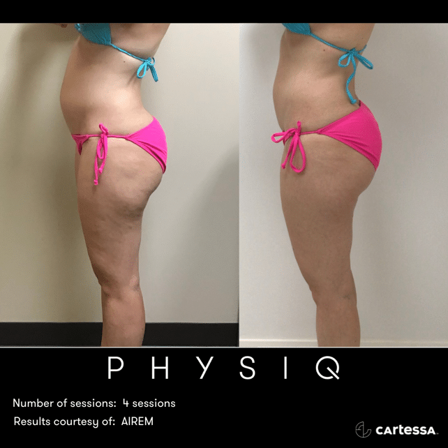 physiq 360 body contouring results before and after
