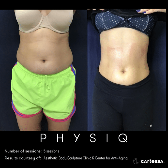 physiq 360 body contouring results before and after