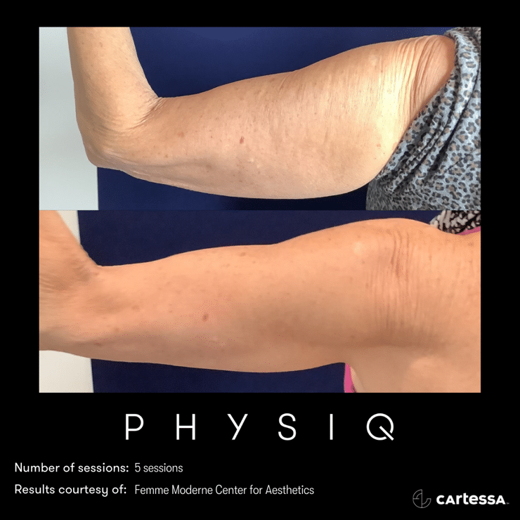 physiq 360 body contouring results before and after