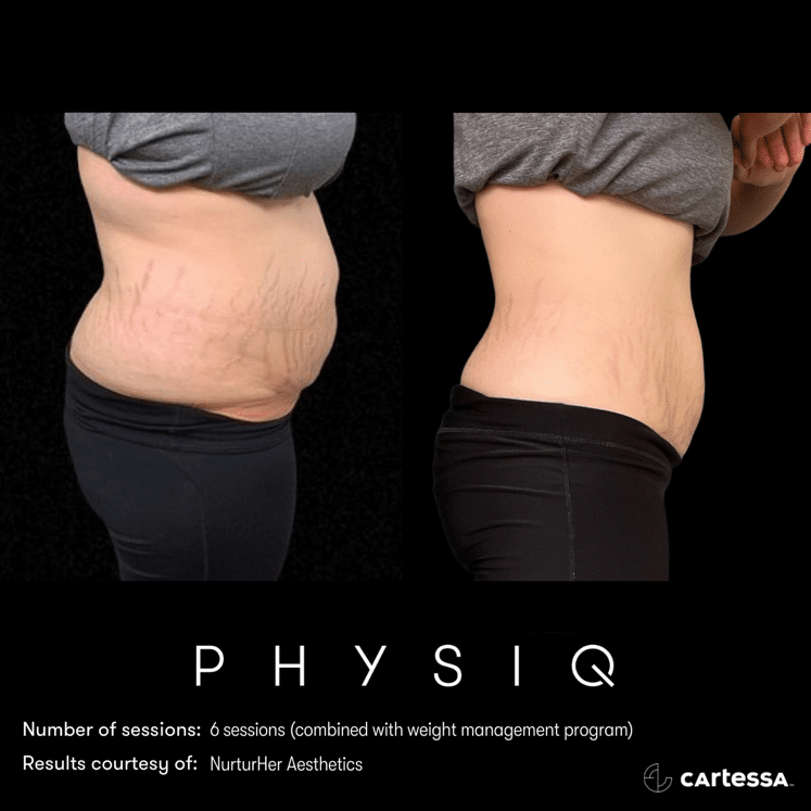 physiq 360 body contouring results before and after