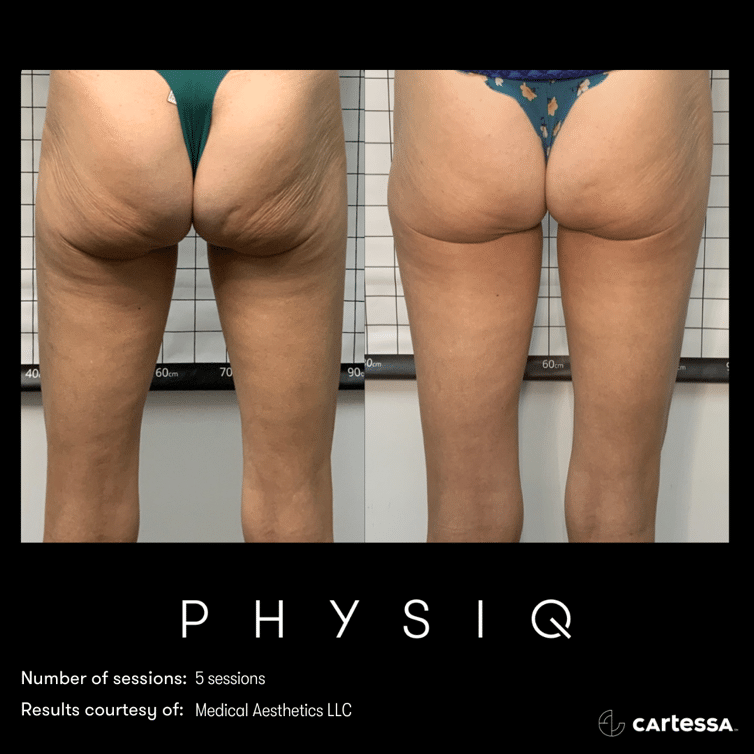 physiq 360 body contouring results before and after