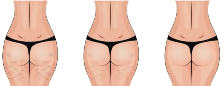 Pulsewave Cellulite Therapy before and after Pulsewave Cellulite Therapy before and after