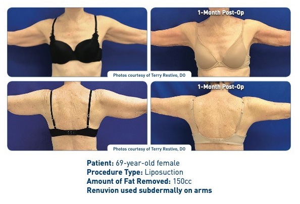 renuvion arm lift before and after results one month after treatment