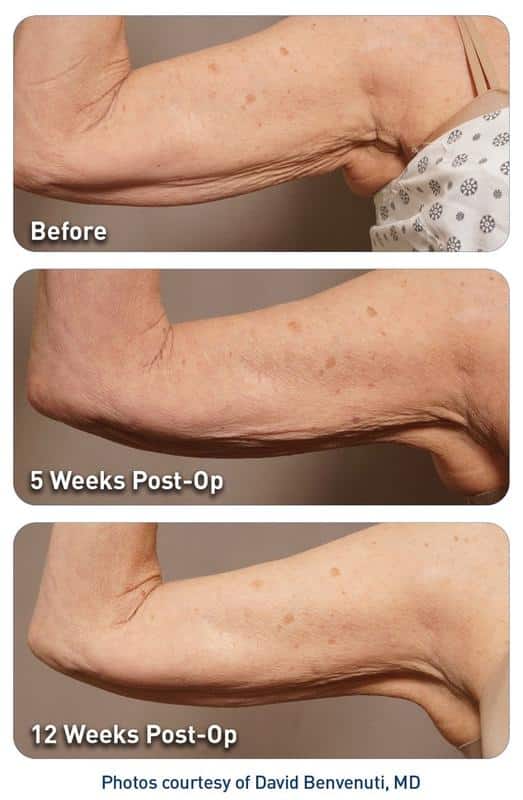 renuvion arm lift patient results 12 weeks after treatment