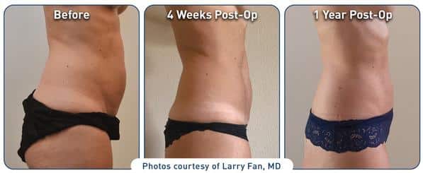 renuvion-j-plasma-before-after-body renuvion j-plasma before and after results on a woman's body