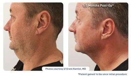 renuvion-j-plasma-before-after-face-man renuvion j-plasma before and after results on a man's face