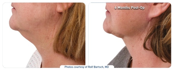 renuvion-j-plasma-before-after-face-woman renuvion j-plasma before and after results on a woman's face