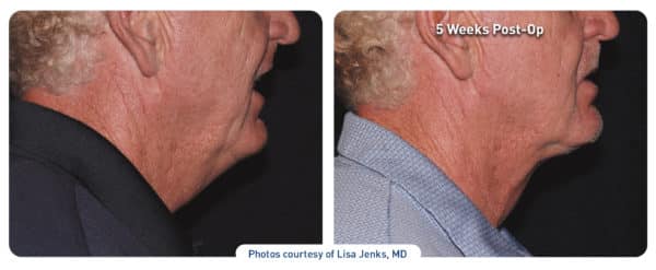 renuvion-j-plasma-before-after-man-2 renuvion j-plasma before and after results on a man's face