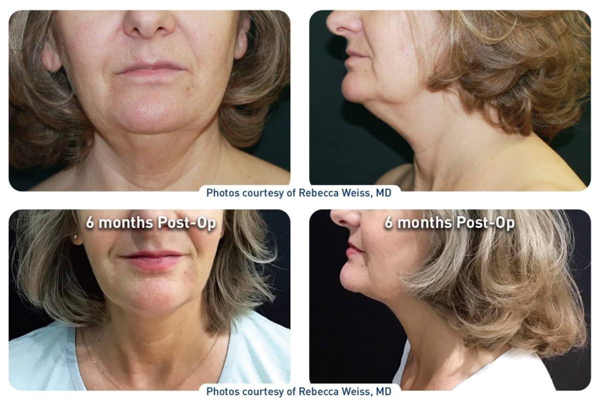 renuvion-j-plasma-patient-results reunvion j plasma patient results