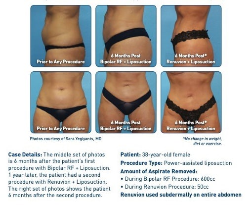 Renuvion J plasma skin tightening Renuvion J plasma skin tightening patient result overview