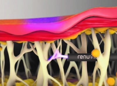 renuvion-j-plasma-skin-tightening-scientific-graphic scientific graphic showing how renuvion j-plasma skin tightening treatment works