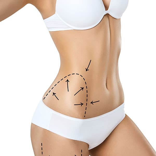 renuvion-j-plasma-skin-tightening a woman's body showing the target areas of renuvion-j-plasma skin tightening procedure