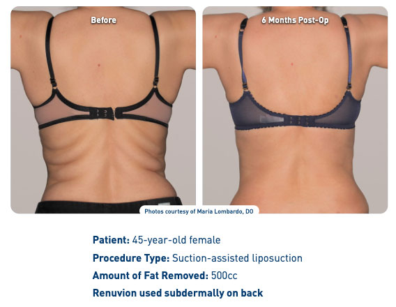 renuvion-j-plasma-with-smartlipo-back renuvion j-plasma with smartlipo treatment used on back patient results