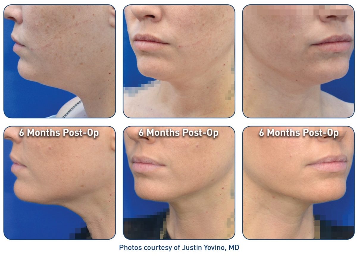 Renuvion J plasma with Smartlipo Renuvion J plasma with Smartlipo patient results face