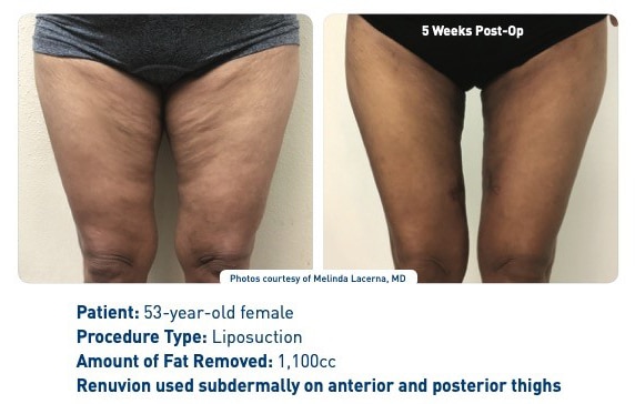 Renuvion J plasma with Smartlipo Renuvion J plasma with Smartlipo patient result overview