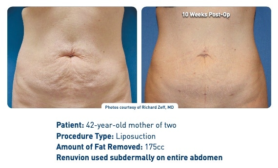 Renuvion J plasma with Smartlipo stomach Renuvion J plasma with Smartlipo stomach patient result overview