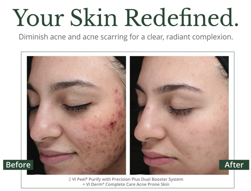 vi peel purify with precision plus for acne scarring before and after results on a woman