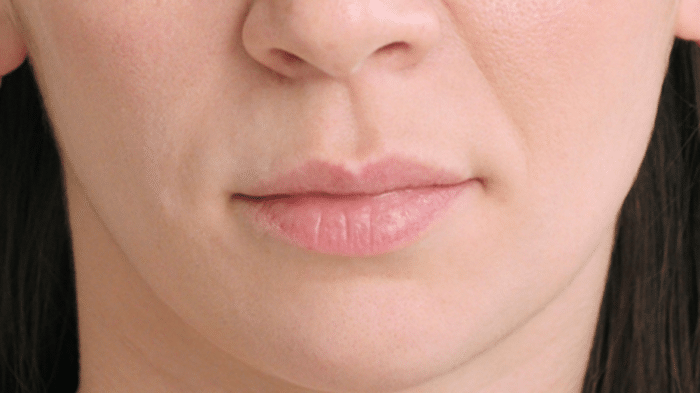 ContemporaryHealth-Naples-restylane-kysse-before ContemporaryHealth-Naples-restylane-kysse-before