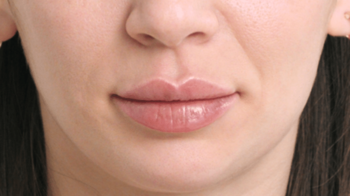 ContemporaryHealth-restylane-kysse-after ContemporaryHealth-restylane-kysse-after