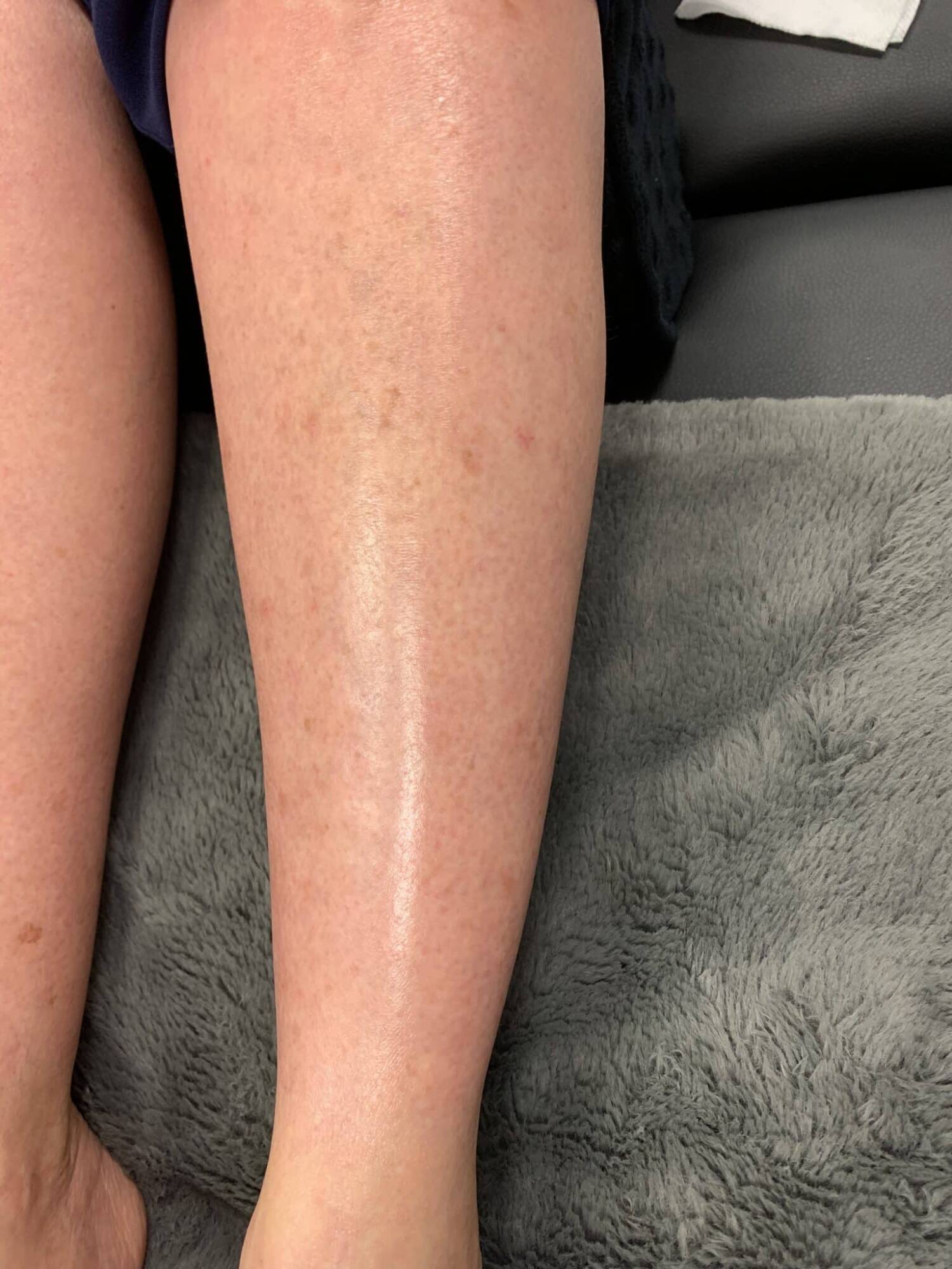 CoolPeel-Tetra-CO2-Skin-Rejuvenation-After