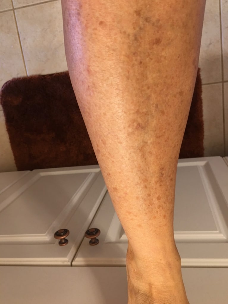 CoolPeel-Tetra-CO2-Skin-Rejuvenation-Before