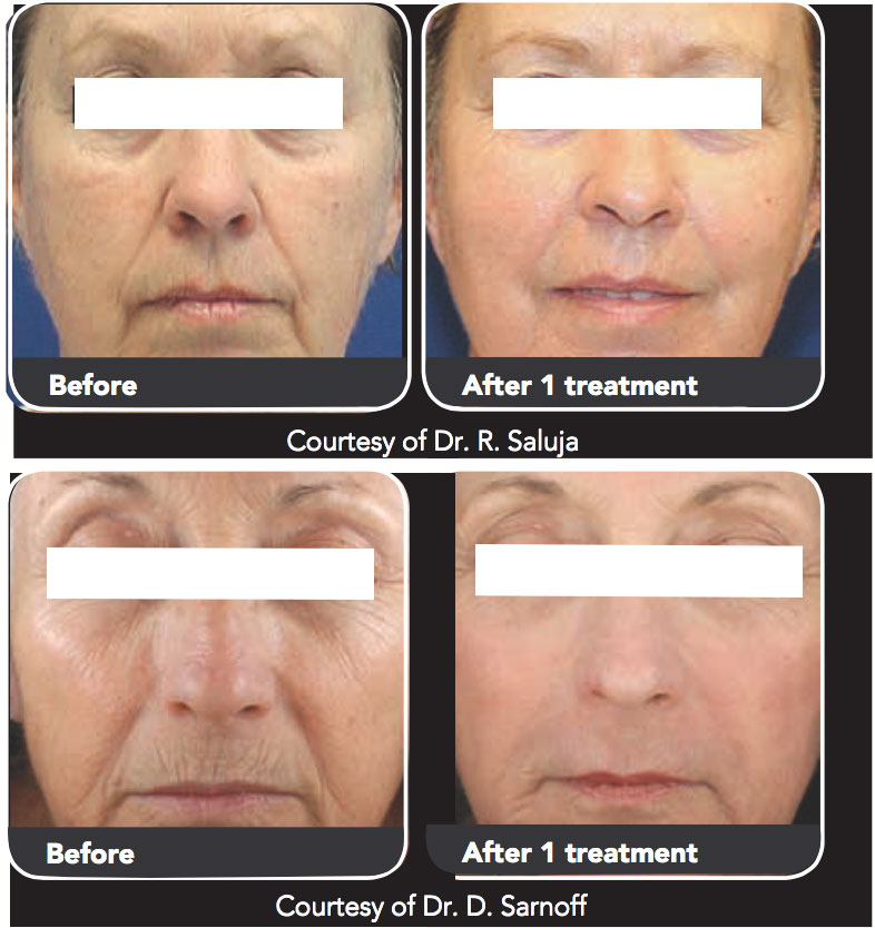 CoolPeel-Tetra-CO2-Skin-Rejuvenation-BeforeAfter1